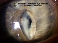 Dislocation of a posterior chamber intraocular lens resulting in the formation of pupillary block glaucoma. Note the dense fibrinous material/membrane covering almost the entire pupil.